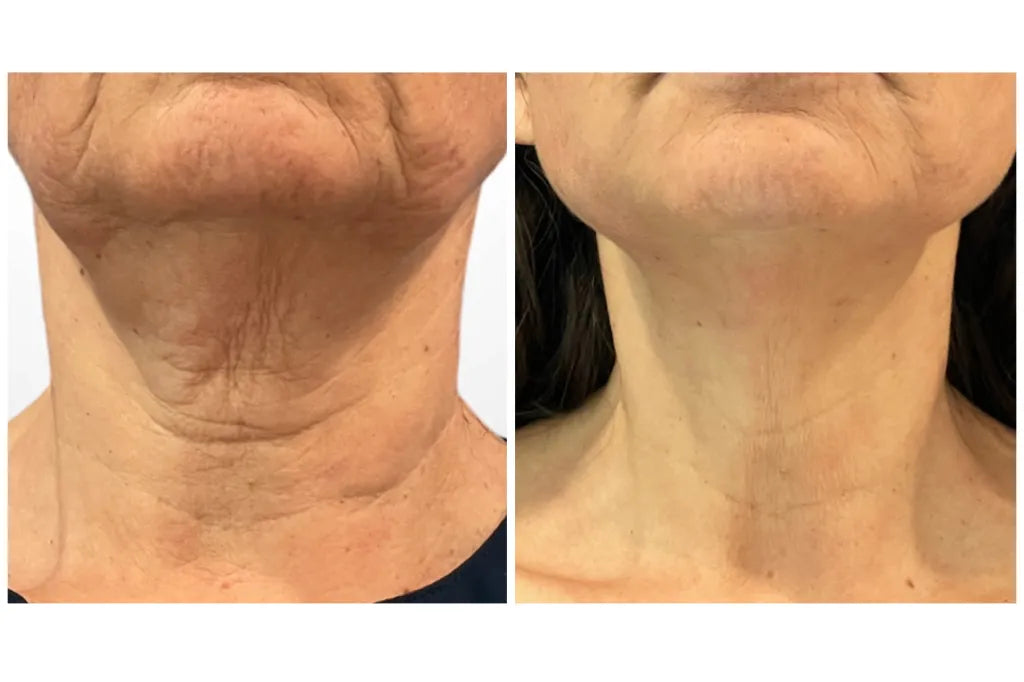 PEAQ Neck Firming Cream