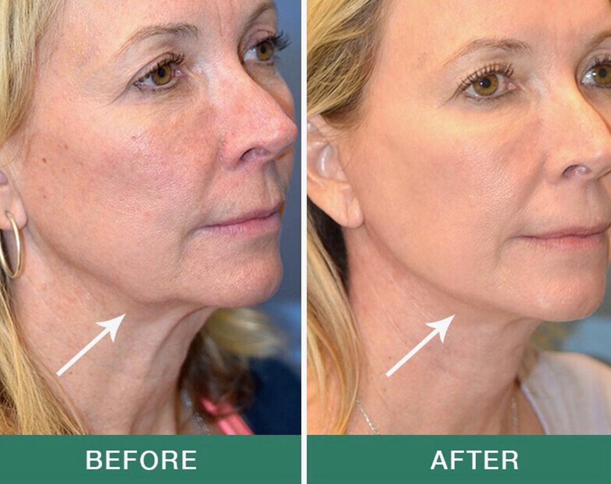 PEAQ Neck Firming Cream