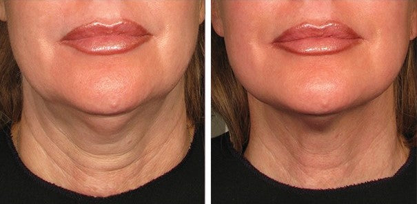 PEAQ Neck Firming Cream